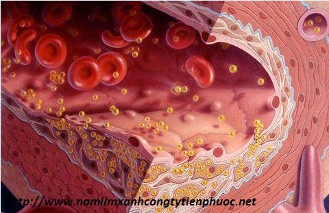 bệnh mỡ máu bệnh mỡ máu