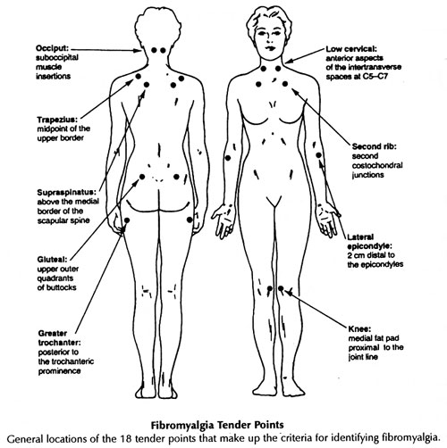 conversations with carolyn my name is fibromyalgia fibromyalgia pressure point chart