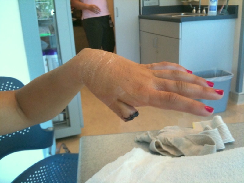 Chopped Off Thumb