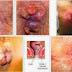 Obat Mujarab Buat Ambeyen Bengkak Berdarah thumbnail