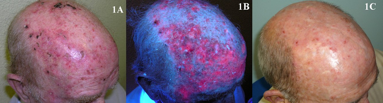 Terapia fotodinamica em dermatologia 66 Terapia fotodinamica em dermatologia 38