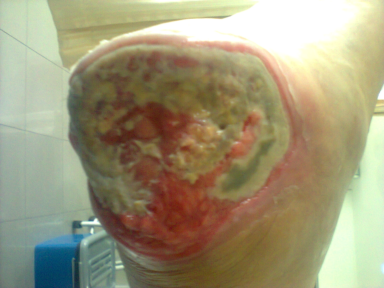 Maggot Debridem...