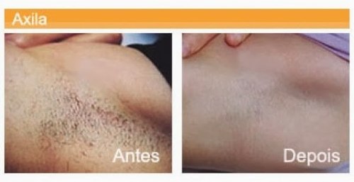 O descoramento forte significa para a pele de cara