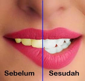 Memutihkan Gigi Kuning Dengan Photoshop Memutihkan Gigi Kuning Dengan Photoshop