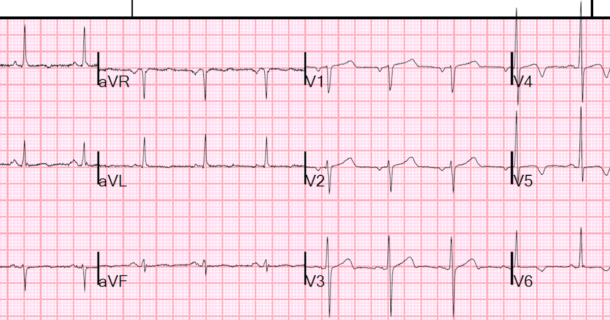 Dr. Smith's ECG Blog A Woman with 8 hours of Ongoing Crushing Chest Pain and Twave Inversion