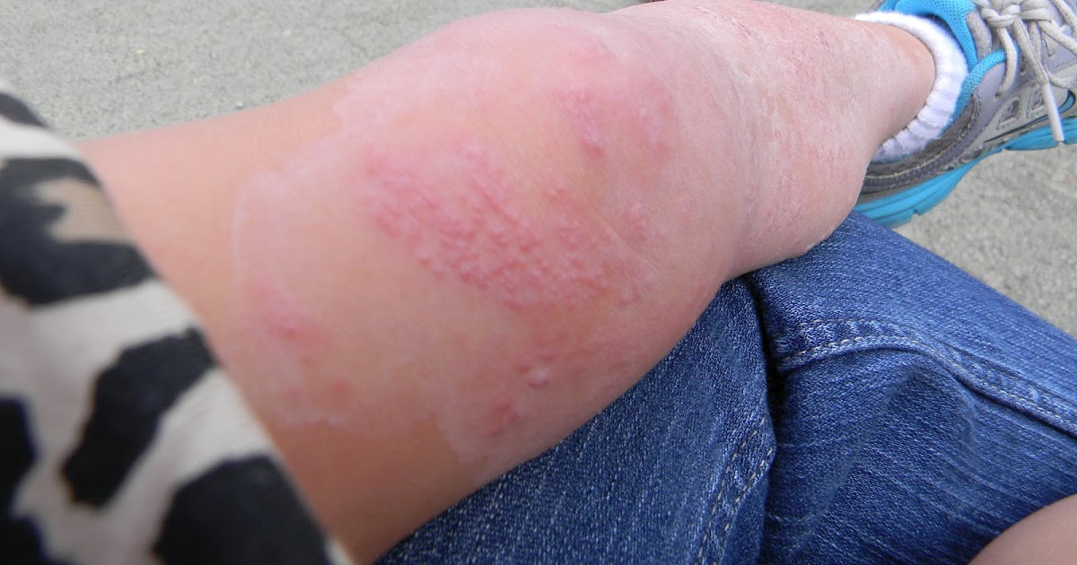 Can i put anything on hand foot and mouth rash