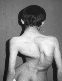 Kelainan Pada Tulang