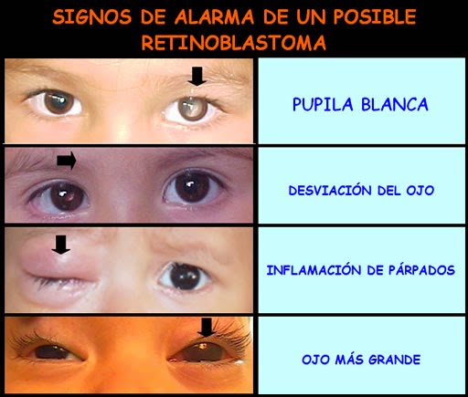 Patogenia De Retinoblastoma Agosto 2014