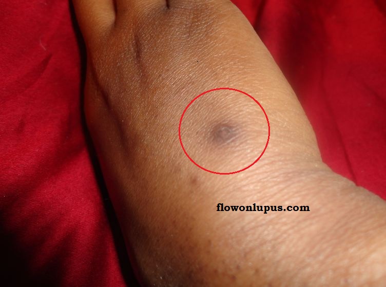 The Life of a 20Something With Lupus Kidney Transplant Battle Scars!