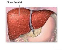 Informatii medicale despre ciroza hepatica