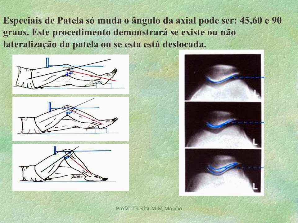 radiologia convencional : Revisando incidências radiológicas de Membros