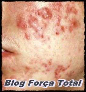 Pele de cara em borbulha de acne