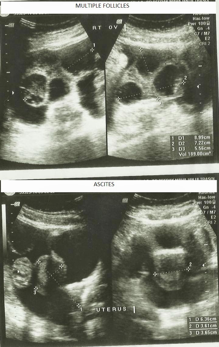 Clomid And Ovarian Hyperstimulation