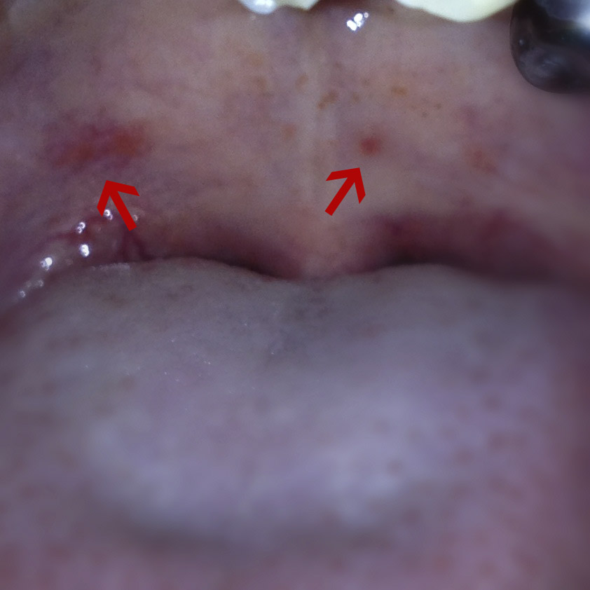 Rough Patch On Roof Of Mouth