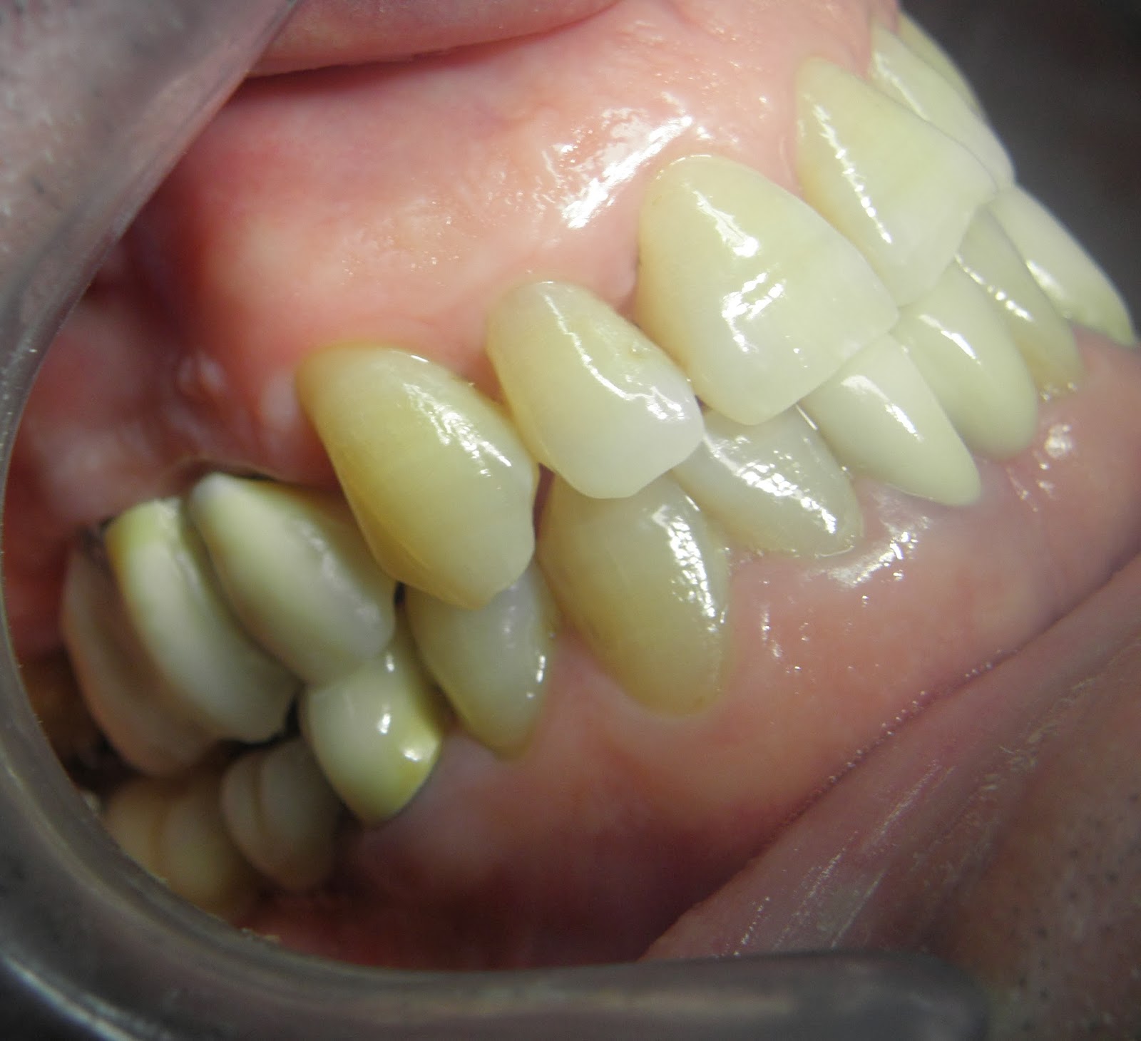 impianti dentali dott Bruno Tortorelli dentista Roma viale della