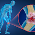 Como fazer a prevenção da Osteoporose