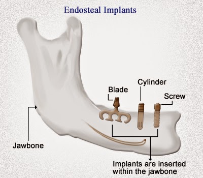 types d'implants dentaires 1