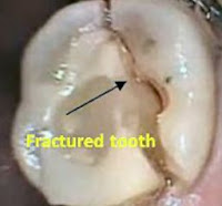 tooth broken cracked chipped fractured bleeding gums