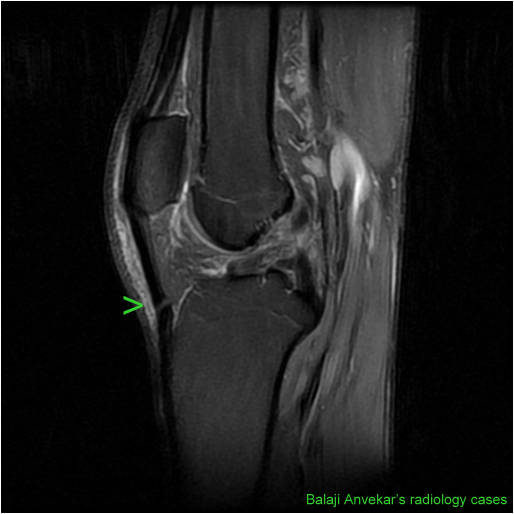 rotator cuff tear mri