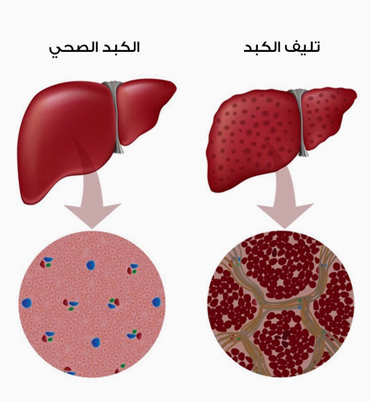 15% من المصريين مصابون بفيروس الكبد الوبائي 7
