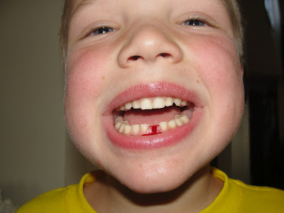 Losing a tooth, teeth pictures