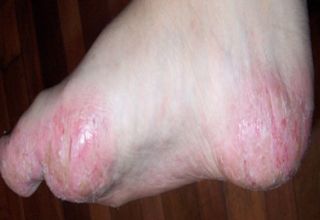 Dyshidrose La dyshidrose est une forme d' eczéma, dit eczéma bulleux, surtout présent sur les faces palmaires et/ou plantaires. Le nom provient du mot dyshidrotique, signifiant mauvaise sueur laquelle fut autrefois perçue comme la cause. Quelquefois elle est appelée Pompholyx (bulles en grec), terme généralement réservé pour les cas de vésicules pruritiques profondes.