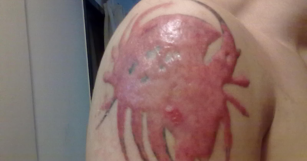 natural tattoo removal top 9 questions about laser natural tattoo removal top 9 questions about laser