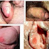 Obat AntiBiotik Yang Ampuh atasi Sipilis thumbnail