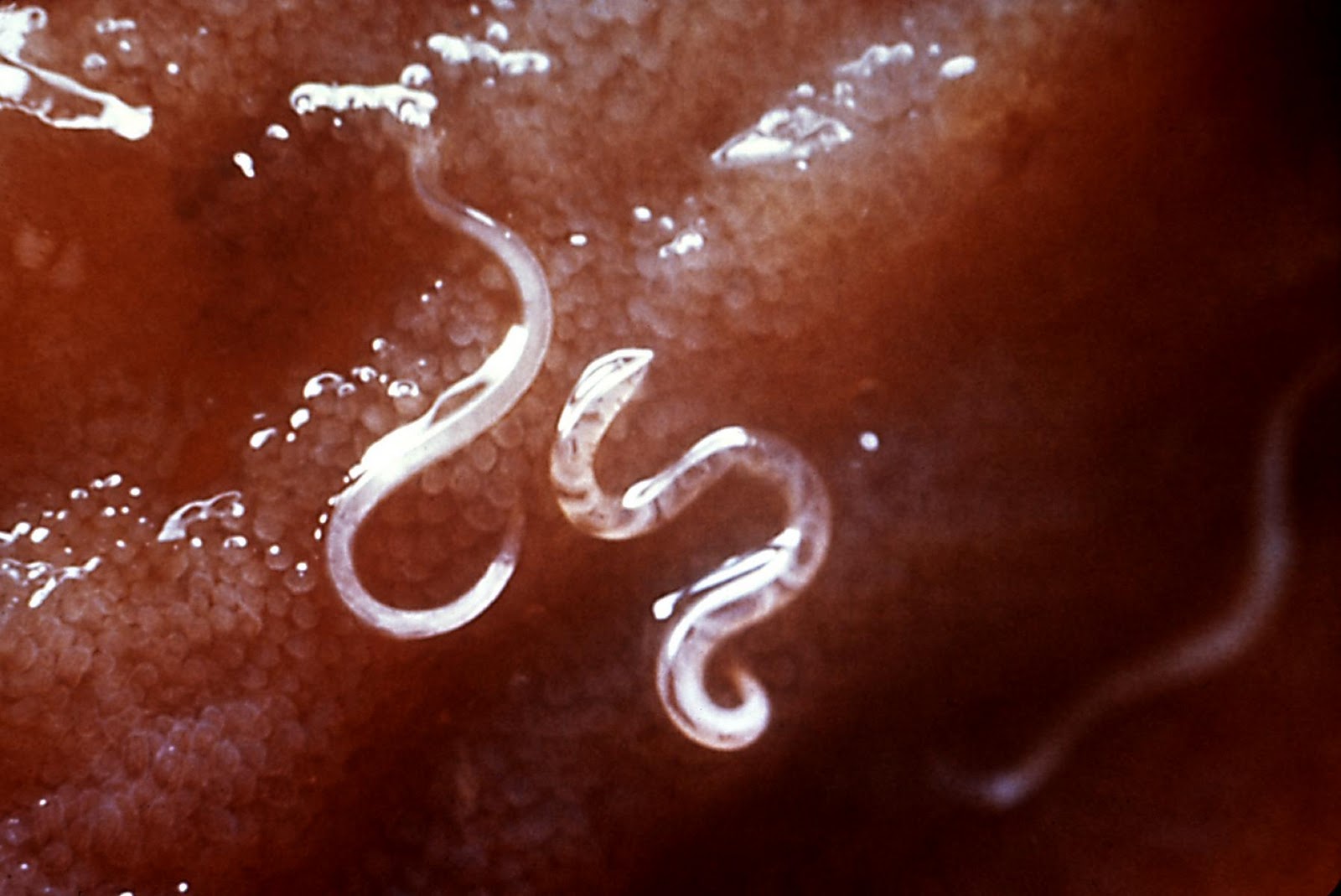 Infection Landscapes Hookworm