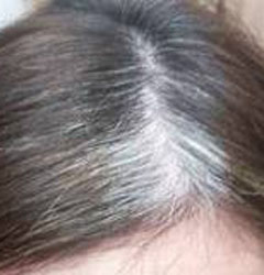 Health Preference Causes Of White Hair