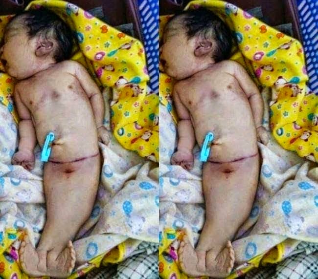 Nace impactante bebé sirena en la India - Imagen 1