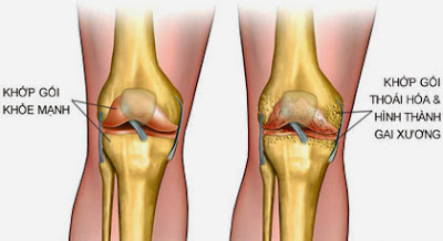 Thuốc trị bệnh thái hóa xương khớp từ USA hiệu quả rõ rệt