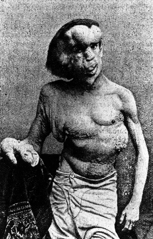 when was the elephant man born
