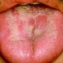 moniliasis