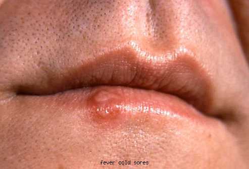 cold sores pictures