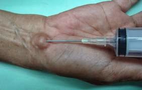 Lipoma treatment steroid injections
