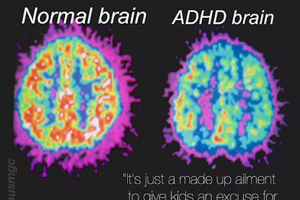 Adventures in Dysfunction: The ADHD Brain \u2013 ADD Resource Center