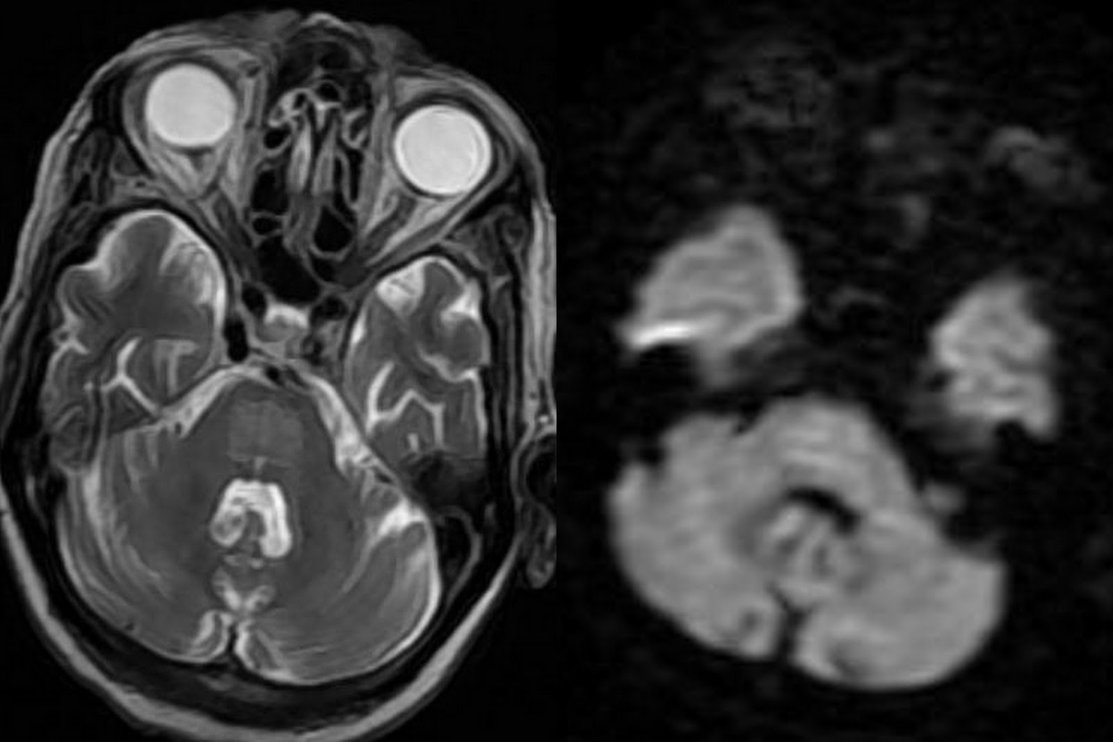Mri Pons