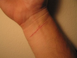  wrists_wound.JPG