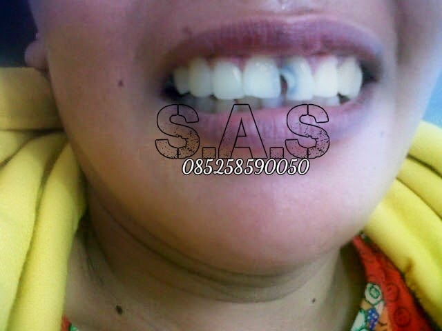 Solusi Gigi Berlubang, Hitam dan Keropos Versi Ahli Gigi S ...