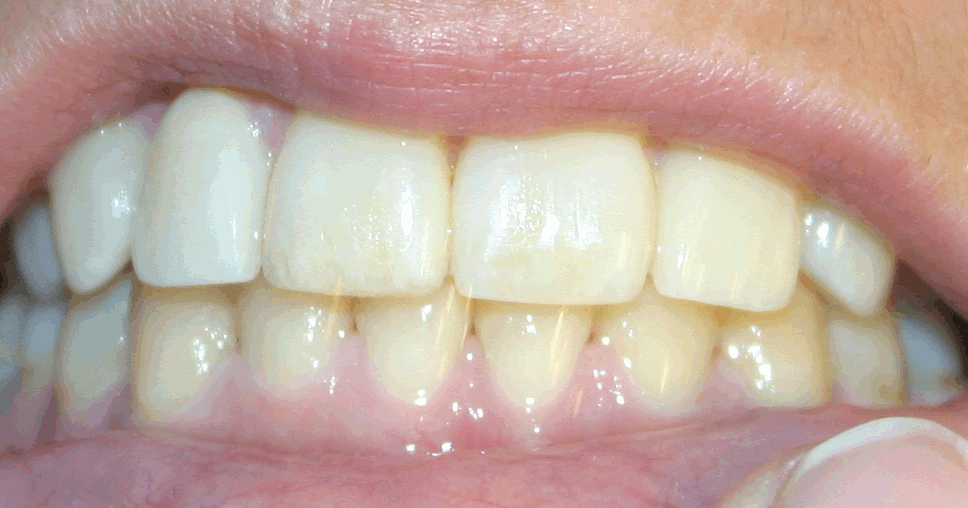 jackedjaw TMJ jaw alignment after 2 years orthodontia