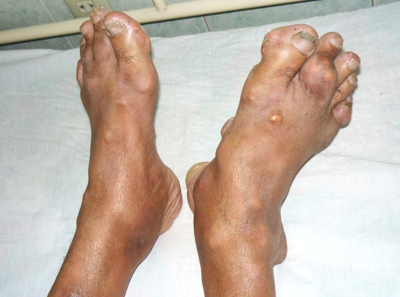 What is gout disease?