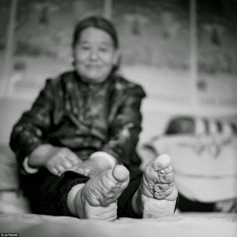 beauty is pain Horrifying 'Lotus Feet' in China