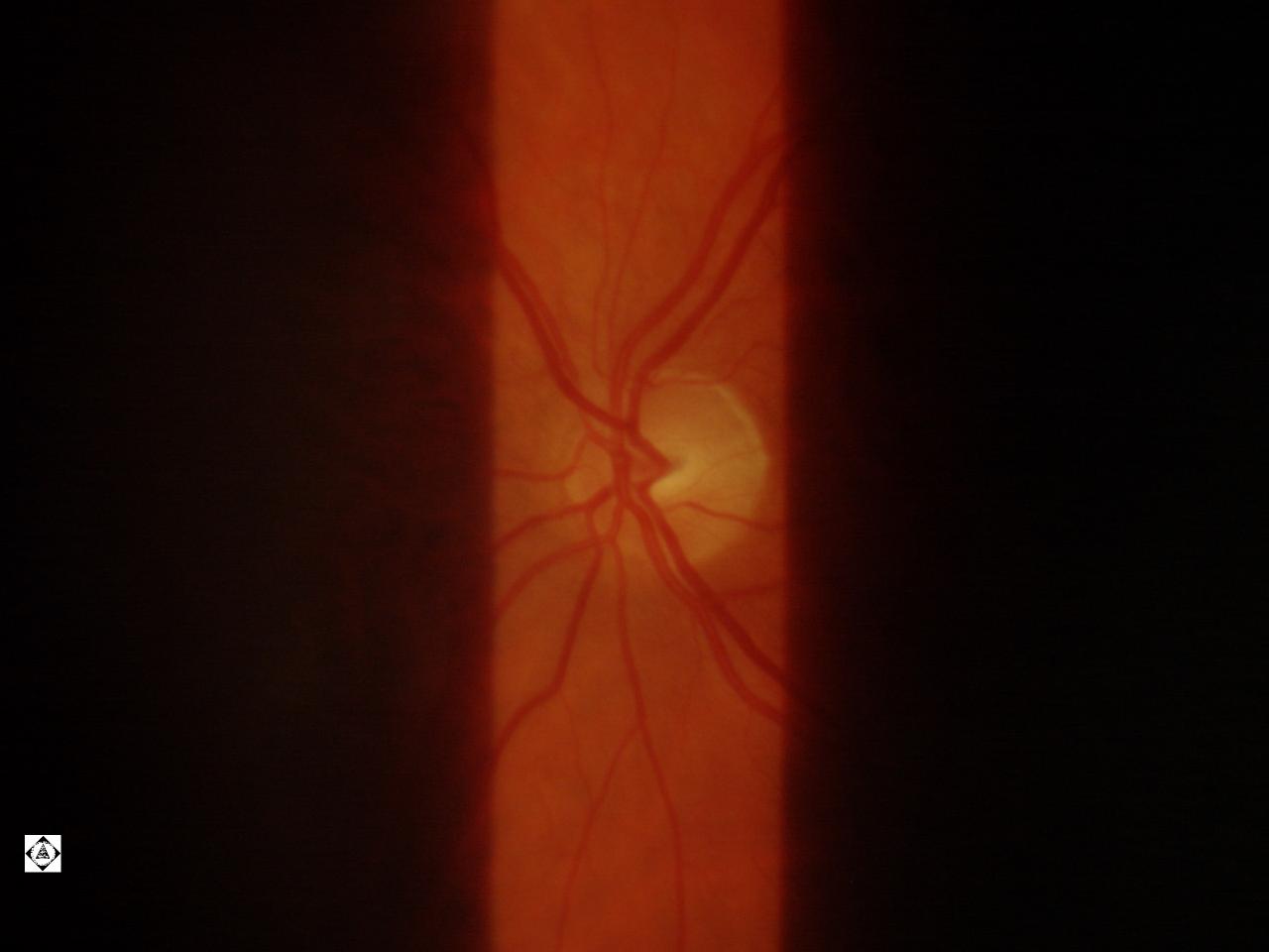 Birth defect in eye Sonoran Desert Eye Center