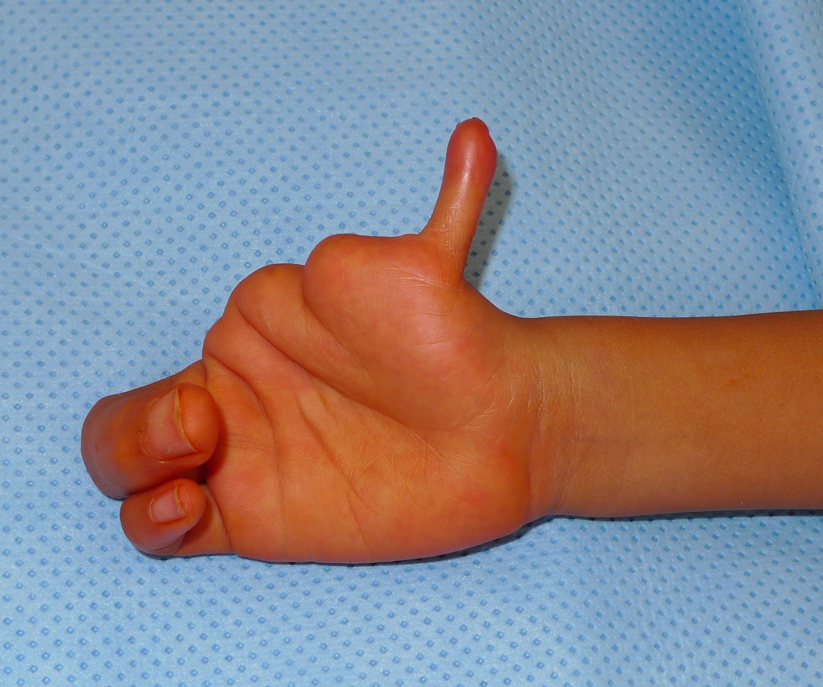 Why does my finger grow dumb Well find out Why does my finger grow dumb Well find out