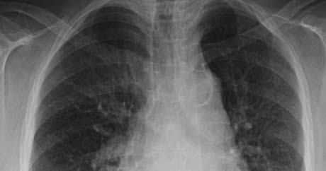 RiT radiology: Sternal Osteomyelitis