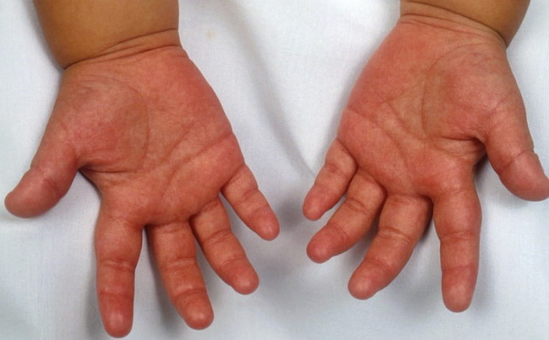 Is Kawasaki Disease Hereditary Is Kawasaki Disease Hereditary