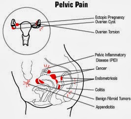 ICD 9 Code For Pelvic Pain
