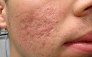 Como Quitar Las Cicatrices De Acne Como Quitar Las Cicatrices De Acne