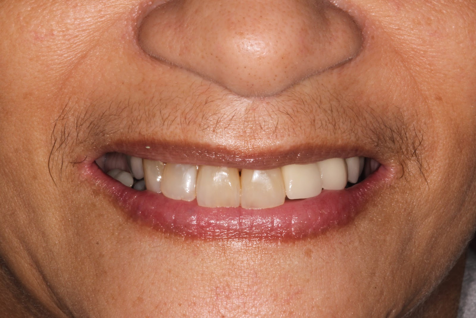 Boise Idaho Prosthodontics Maxillary Teeth and Mandibular Semiprecision Removable Partial